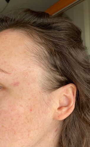 Frische Narbe - Farbstofflaser