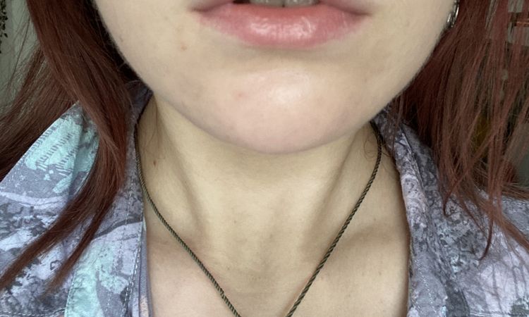 Asymmetrische, schiefe Lippen korrigieren - empfehlenswert? - 53419