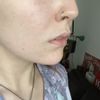 Asymmetrische, schiefe Lippen korrigieren - empfehlenswert?