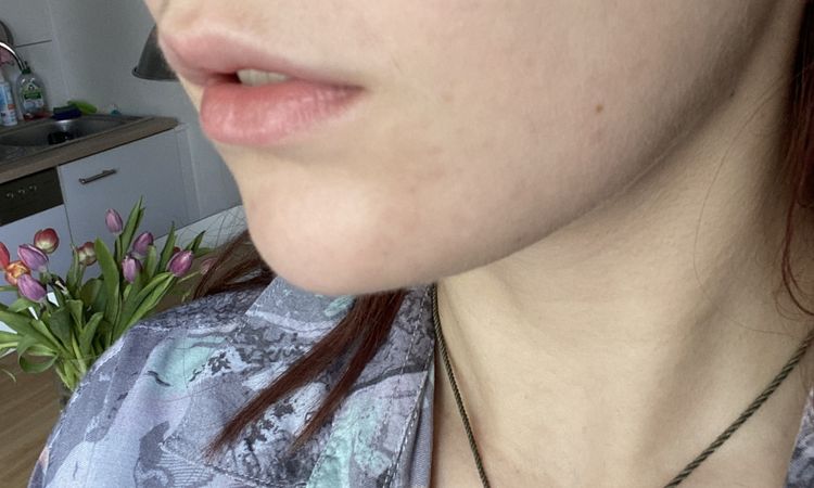 Asymmetrische, schiefe Lippen korrigieren - empfehlenswert? - 53421