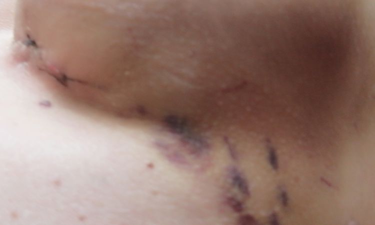Brust Vergrößerung Post OP Hämatome - 53513
