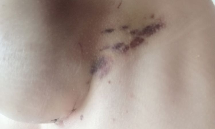 Brust Vergrößerung Post OP Hämatome - 53514