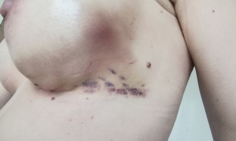 Brust Vergrößerung Post OP Hämatome - 53517