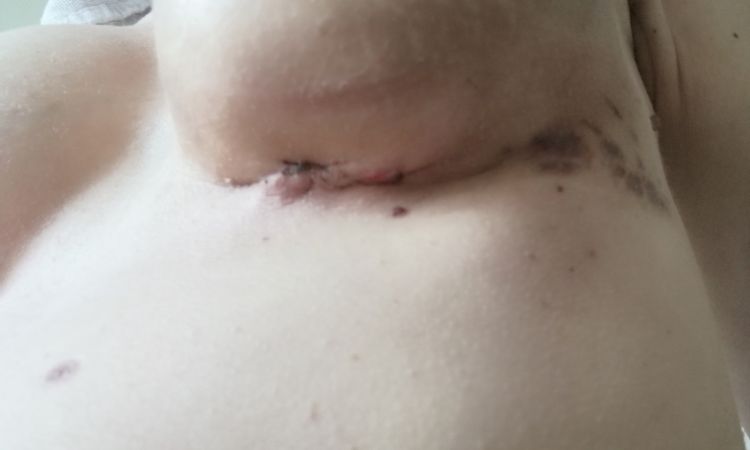 Brust Vergrößerung Post OP Hämatome - 53519