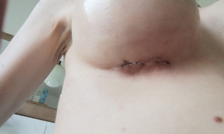 Brust Vergrößerung Post OP Hämatome - 53520