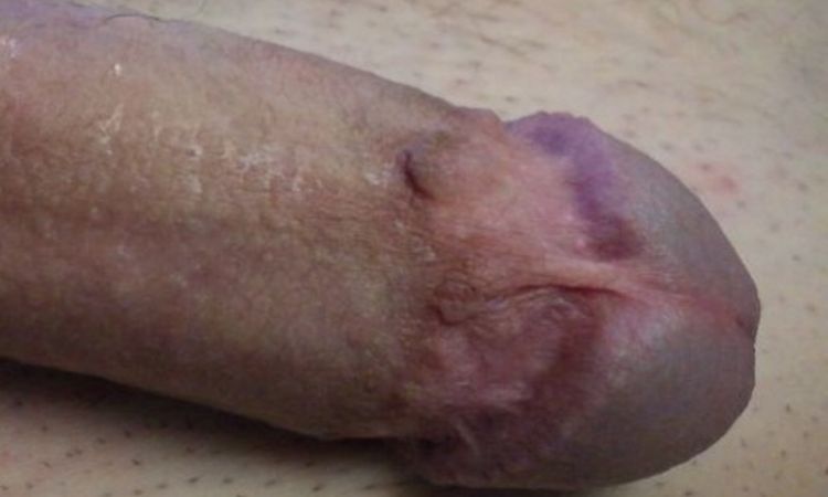 Unschöne Narbe - Nachbeschneidung möglich? - 53682