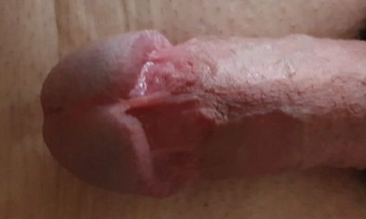 Unschöne Narbe - Nachbeschneidung möglich? - 53683