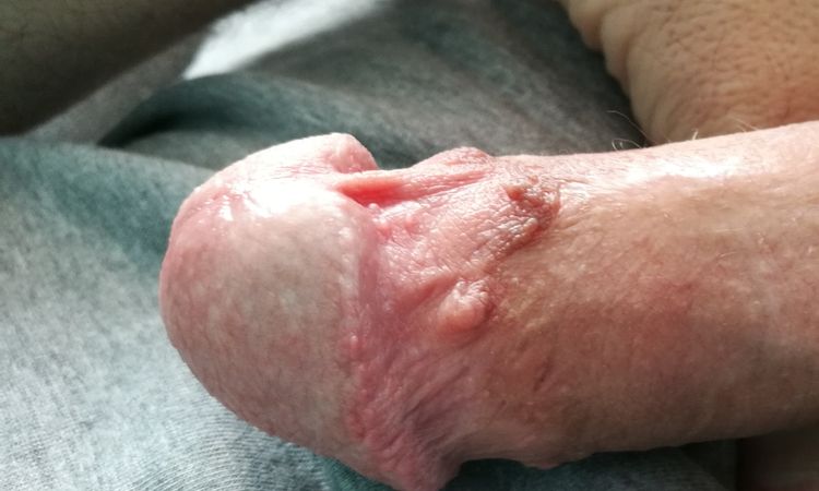 Unschöne Narbe - Nachbeschneidung möglich? - 53688