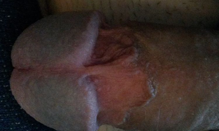 Unschöne Narbe - Nachbeschneidung möglich? - 53689