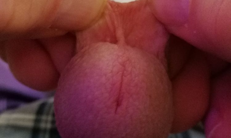 Unschöne Narbe - Nachbeschneidung möglich? - 53690