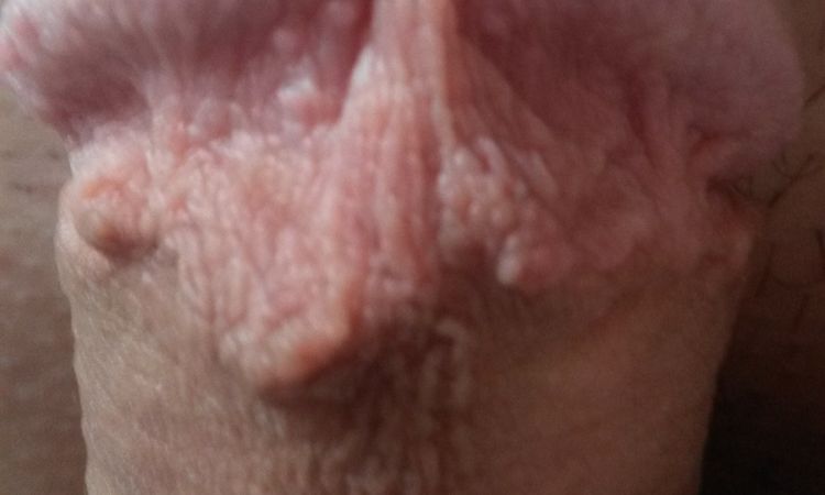 Unschöne Narbe - Nachbeschneidung möglich? - 53691