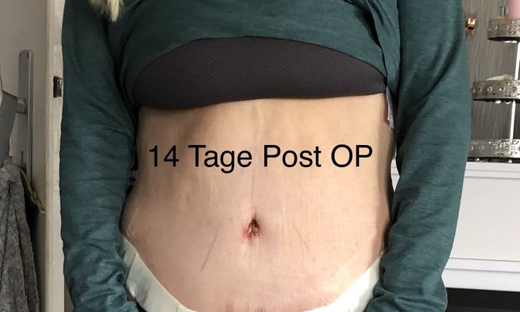 Zweitmeinung zu meiner Bauchdeckenstraffung - 53766
