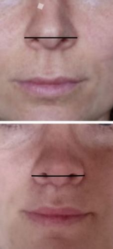 Bullhorn Lip Lift -veränderte Nase?!