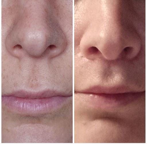 Bullhorn Lip Lift -veränderte Nase?!