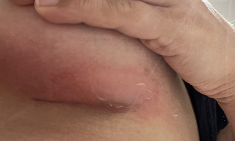 Blase unter der Brust 7 Wochen nach BV - 54446