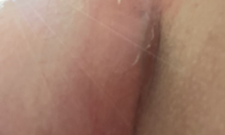 Blase unter der Brust 7 Wochen nach BV - 54448