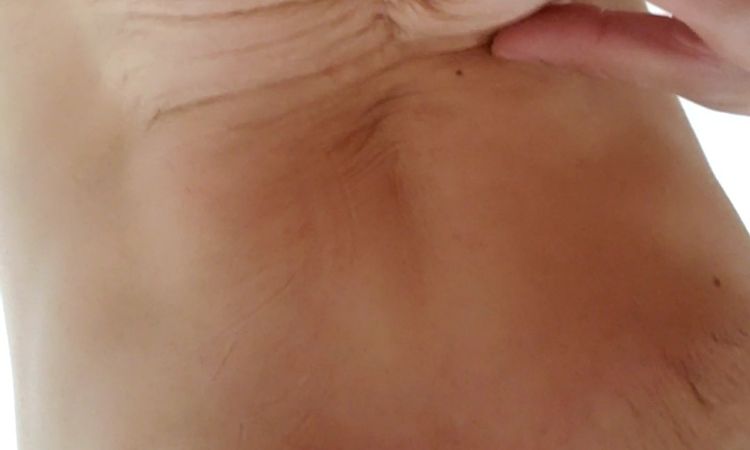 Brust- und Bauchstraffung - 54512