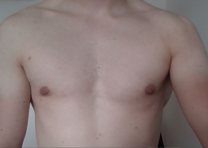 Korrektur nach GynäkomastieOP Estheticon.de