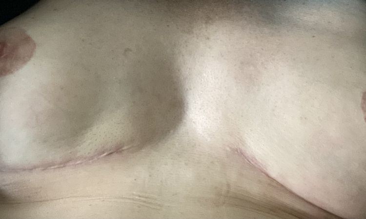 Brustrekonstruktion mit Tiloop Bra - 54837