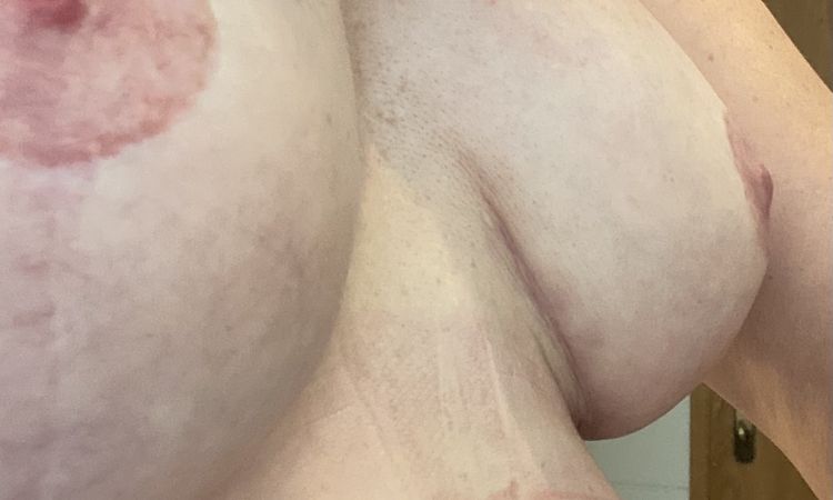 Brustrekonstruktion mit Tiloop Bra - 54839
