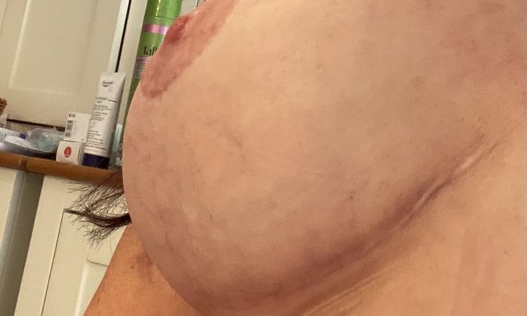 Brustrekonstruktion mit Tiloop Bra - 54840