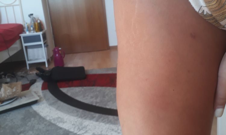 Verhärtungen und Unförmigkeit nach Liposuktion an Beinen - 54867