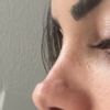Nasen OP / Narbenbehandlung mit Kristallkortison