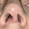 Nasenkorrektur (HNO) missglückt