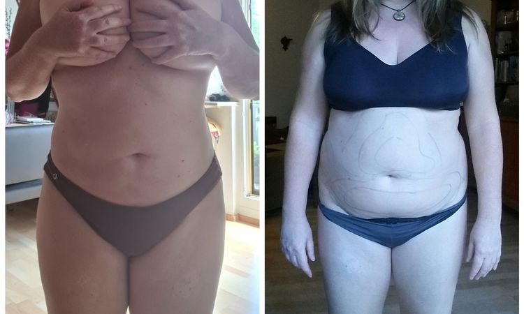 Ist die Liposuktion gelungen? - 55293