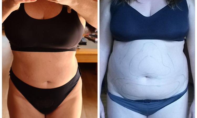 Ist die Liposuktion gelungen? - 55294