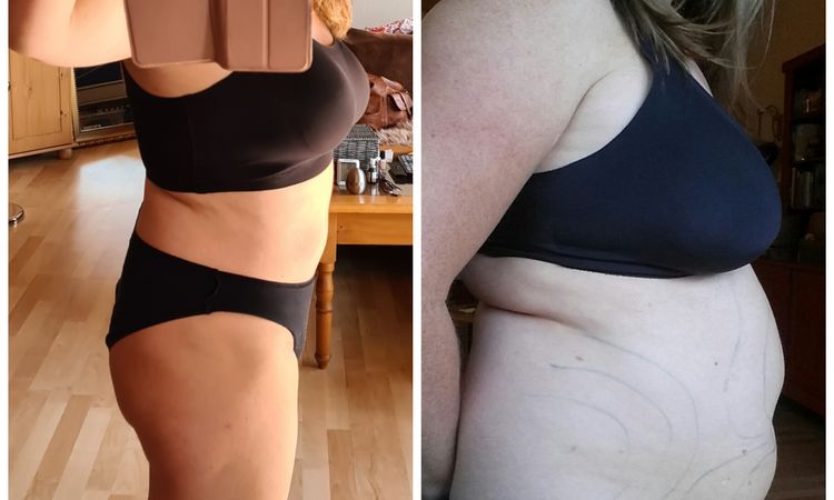 Ist die Liposuktion gelungen? - 55295