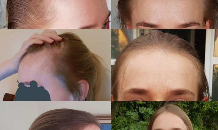 Kommt für mich (28) eine Haartransplantation in Frage? - 55690