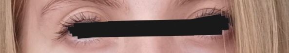 Doppelte Lidfalte an einem Auge, wie kann man das korrigieren? - 56082