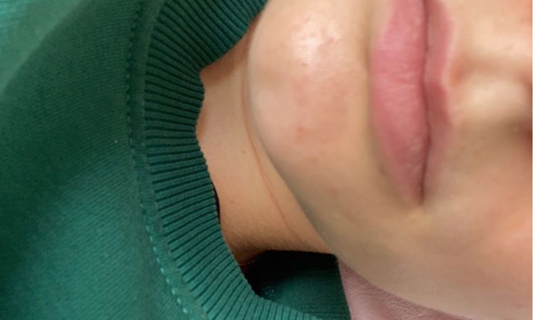 Lippenlifting kompatibel mit Nasenspitzenlift? - 56381