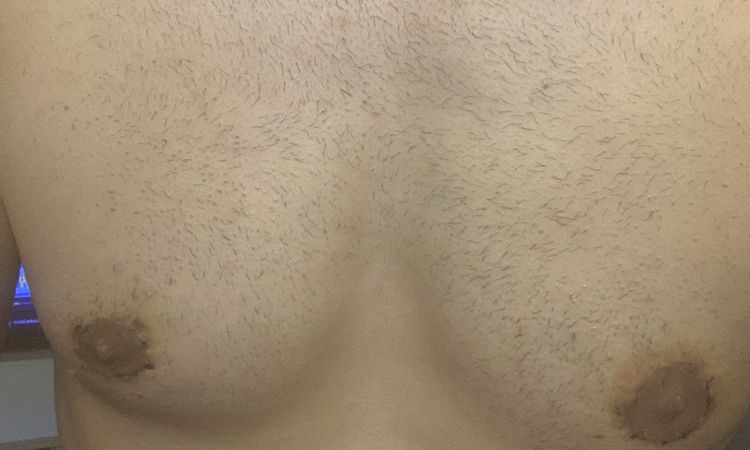Gynäkomastie Entfernung/ Jahre später Narbenkorrektur und Brustwarzenkorrektur - 56675