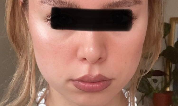 Kinnplastik, Kinnlipo + Bichatentfernung oder Facelift? - 56917