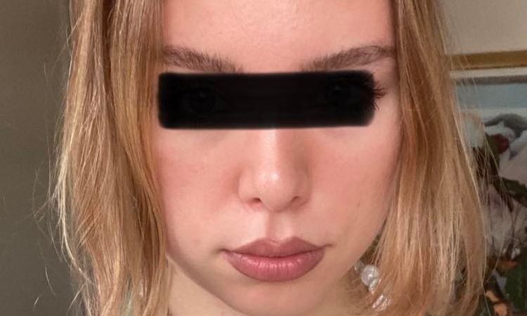 Kinnplastik, Kinnlipo + Bichatentfernung oder Facelift? - 56918