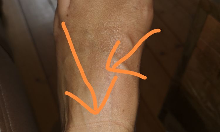 Schmerzen im Fuß nach Liposuktion der Beine komplett - 57813