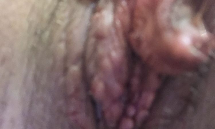 4. Mal nähen nach Wundheilungsstörung - 59629