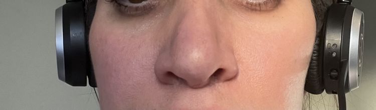 2. Nasen OP - Schwellung geht nicht weg - Estheticon.de