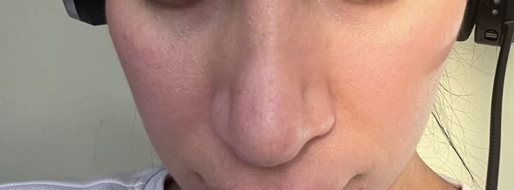2. Nasen OP - Schwellung geht nicht weg - Estheticon.de