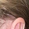 Ohrenkorrektur nicht zufrieden / überkorrigiert - 59756