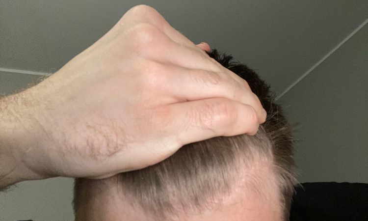 Ist in meinem Stadium + Alter (26.) eine Haartransplantation schon sinnvoll? - 60129