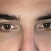 Dunkle Augenringe trotz Hyaluronsäure