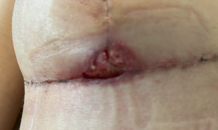 Loch nach Bruststraffung! Hilft ein Klammerpflaster? - 60498