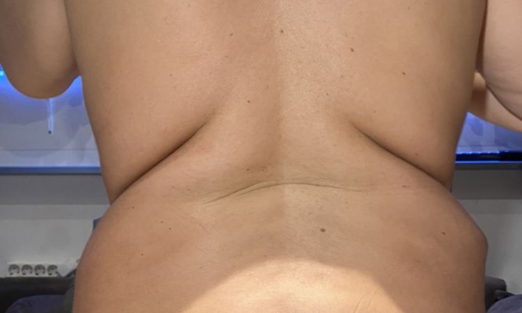Muss der Rücken gestrafft werden? Oder reicht eine Lipo? - 60858