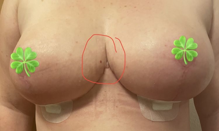 Hautwulst nach Brustverkleinerung im Dekolleté - 60943