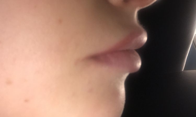 Lip und Nose Lift in einem? - 60967