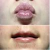 Hyaluron lässt sich nicht auflösen + weiße Stellen an den Lippen - 61403
