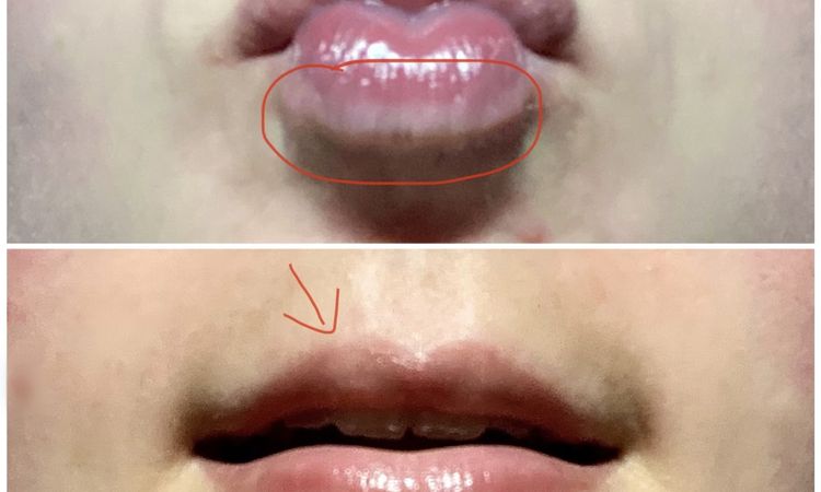 Hyaluron lässt sich nicht auflösen + weiße Stellen an den Lippen - 61403